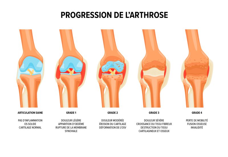 ARTHROSE DU GENOU